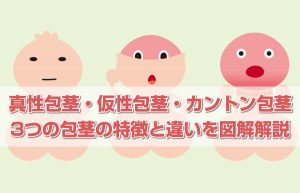【図解】真性包茎・仮性包茎・カントン包茎。各種類の特徴と違い