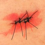 傷痕が目立たない包茎手術とは?~重要な5つのポイント