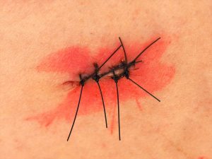 傷痕が目立たない包茎手術とは?～重要な5つのポイント