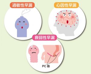 【徹底解説】過敏性早漏・心因性早漏・衰弱性早漏の原因と違い
