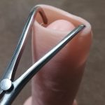 キトー君DXを自腹購入したので本音でレビュー! ~ 本当に包茎は治る?